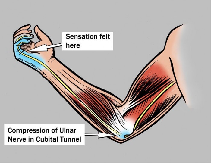 Cubital Tunnel Syndrome What S That Alexandria Rehabilitation