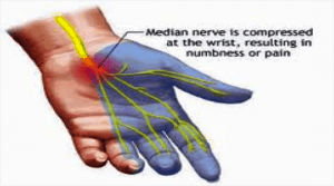 Numbness and pain is caused by compression of the median nerve where the hand meets the wrist, which is called the carpal tunnel. That is why this condition is called "Carpal Tunnel Syndrome".