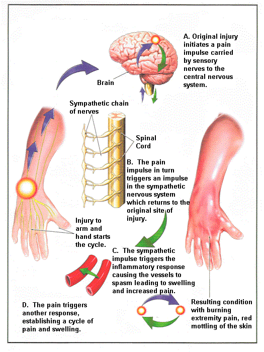 CRPS