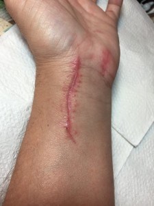 Scar after surgery